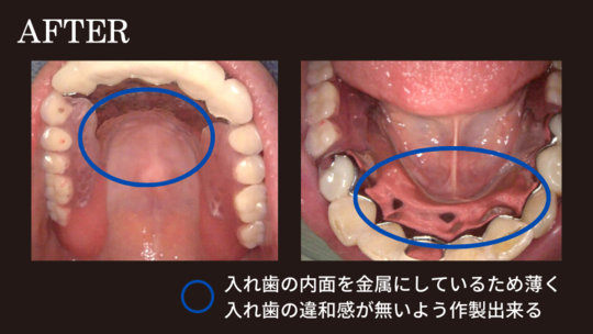 ノンクラスプデンチャー＋金属床の部分入れ歯の症例「違和感がある